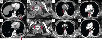 Microwave ablation plus camrelizumab monotherapy or combination therapy in non-small cell lung cancer
